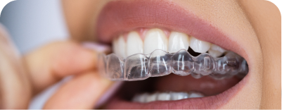Alineadores invisibles